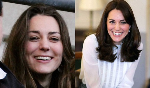 kate middleton before and after lingual braces treatment