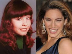 kelly brooks before and after lingual braces treatment