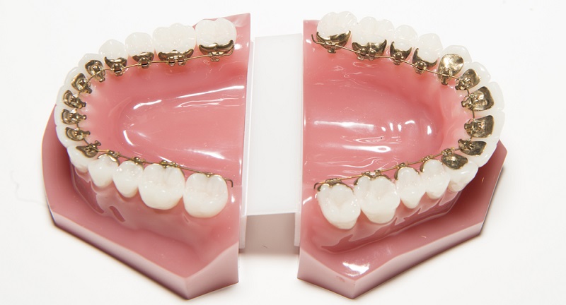 Lingual Braces: Efficacy, Cost & Comparisons