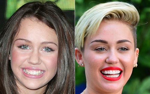 miley cyrus before and after lingual braces treatment