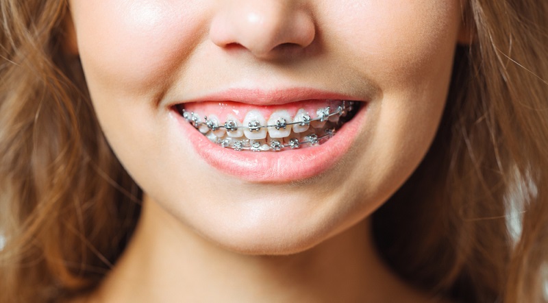 Self-Ligating Braces vs Metal Braces: Cost, Pros & Cons, Pictures, FAQs