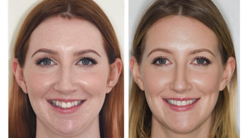 sharon farrell before and after lingual braces treatment