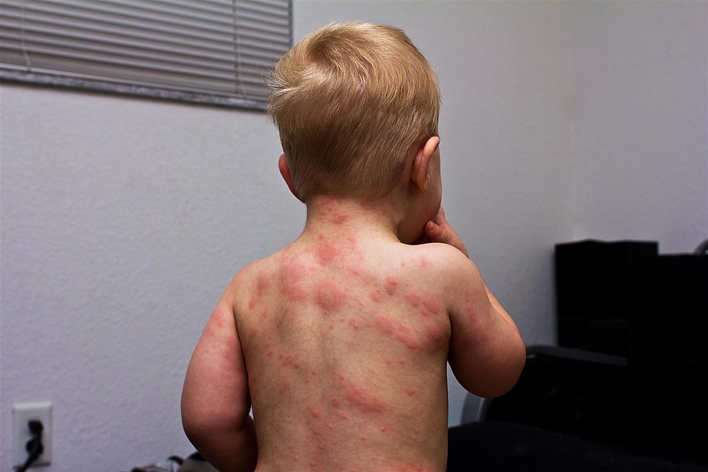 Roseola (Sixth Disease) Symptoms & Causes